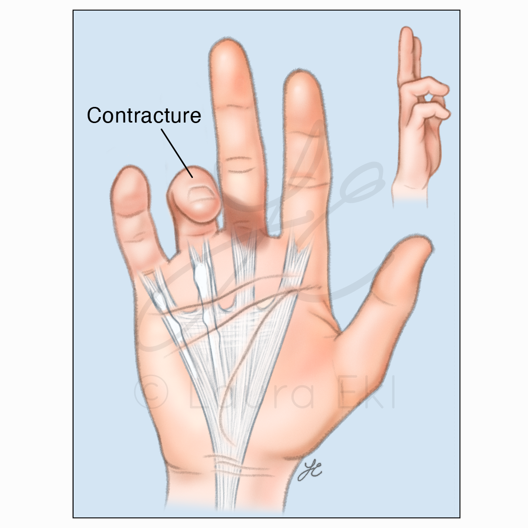 Progression of Dupuytren’s Disease